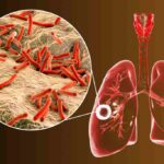 Tuberkulosis: Penyebab, Gejala, Pengobatan, dan Pencegahan