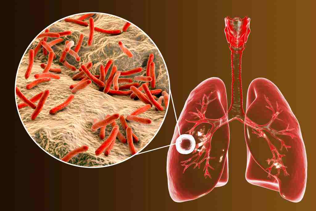 Tuberkulosis: Penyebab, Gejala, Pengobatan, dan Pencegahan