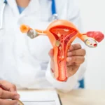 Polikistik Ovarium Syndrome (PCOS): Penyebab, Gejala, dan Cara Penanganannya