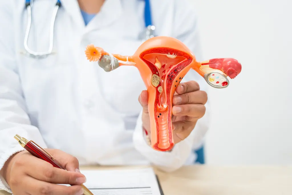 Polikistik Ovarium Syndrome (PCOS): Penyebab, Gejala, dan Cara Penanganannya